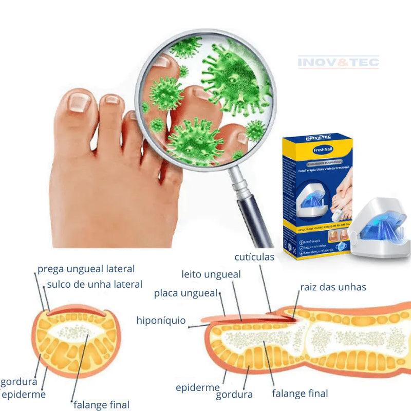Dispositivo De FotoTerapia Ultra Violeta FreshNail - Tratamento Eficiente Para Doenças e Fungos De Unhas [QUEIMA DE ESTOQUE ULTIMAS UNIDADES - 50% De Desconto]